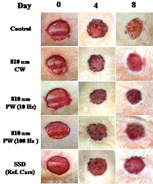 Wound healing with the Physiolaser