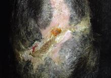 Infected skin wound healing after laser therapy